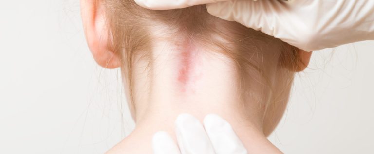 Doctor hand in white rubber protective gloves showing red spot of blood vessels on toddler girl neck skin from birth. Baby healthcare concept. Closeup. Back view. Doctor hand in white rubber protective gloves showing red spot of blood vessels on toddler girl neck skin from birth. Baby healthcare concept. Closeup. Back view.
