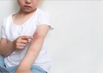 Crveni alarm na koži: Osipne bolesti i kako reagirati na vrijeme