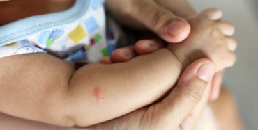 Ubodi komaraca kod djece: Kako zaštititi osjetljivu kožu prirodnim putem