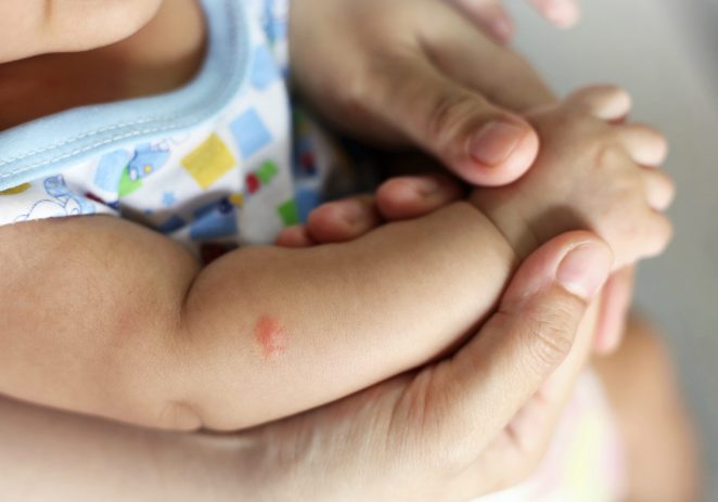 Ubodi komaraca kod djece: Kako zaštititi osjetljivu kožu prirodnim putem